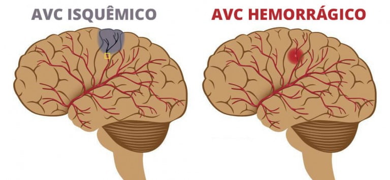 O Que é E Como Tratar O Avc Clínica Regenerati Neurologia Neurologia Hoje 7501